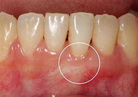 牙 本質 外露 治療